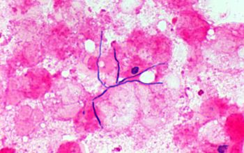 Actinomyces israelii Gram stain