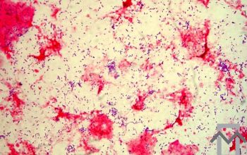 Actinomyces odontolyticus (Schaalia odontolytica) Gram stain