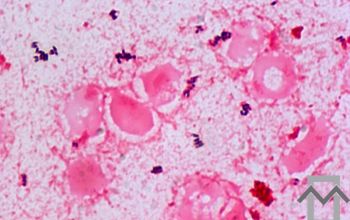 Actinomyces odontolyticus (Schaalia odontolytica) Gram stain