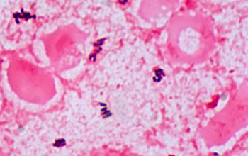 Schaalia odontolytica  (Actinomyces odontolyticus) Gram stain