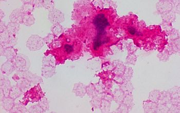 Aggregatibacter actinomycetemcomitans Gram stain