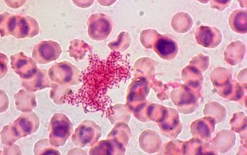 Aggregatibacter aphrophilus Gram stain