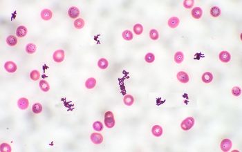 Corynebacterium striatum Gram stain