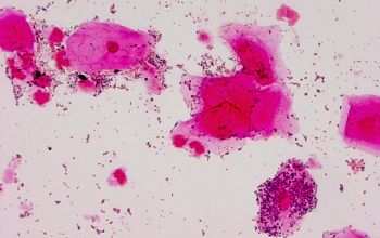 Gardnerella vaginalis Gram stain