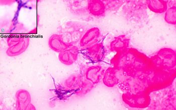 Gordonia bronchialis Gram stain