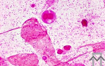Haemophilus influenzae Gram stain