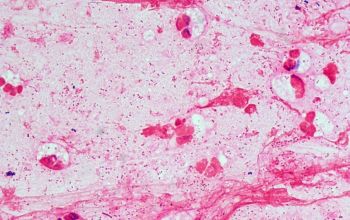 Haemophilus influenzae Gram stain