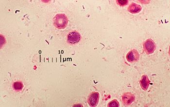 Mycobacterium abscessus (Mycobacteroides abscessus)( Gram stain