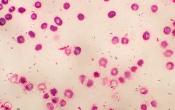 Mycobacterium abscessus (Mycobacteroides abscessus)( Gram stain