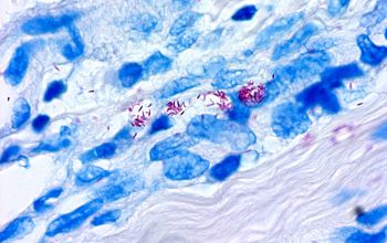 Mycobacterium leprae Ziehl Niessen stain