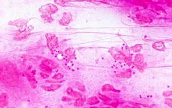 Neisseria gonorrhoeae Gram stain