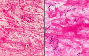 Nocardia farcinica Gram stain