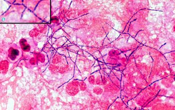 Nocardia otitidiscaviarum Gram stain