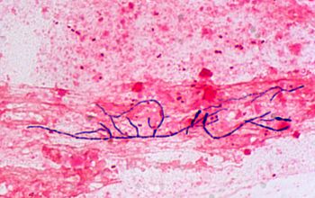 Nocardia otitidiscaviarum Gram stain