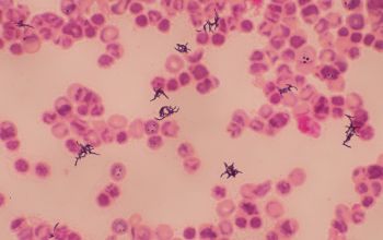 Propionibacterium acnes (Cutibacterium acnes) Gram stain