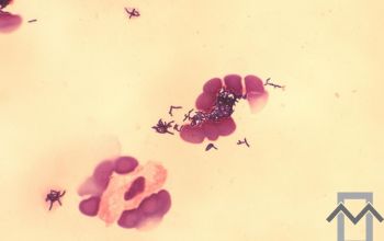 Propionibacterium acnes (Cutibacterium acnes) Gram stain