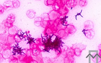 Propionibacterium acnes (Cutibacterium acnes) Gram stain