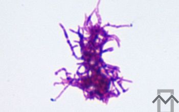 Propionibacterium acnes (Cutibacterium) Gram stain