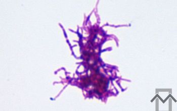 Propionibacterium acnes (Cutibacterium acnes) Gram stain